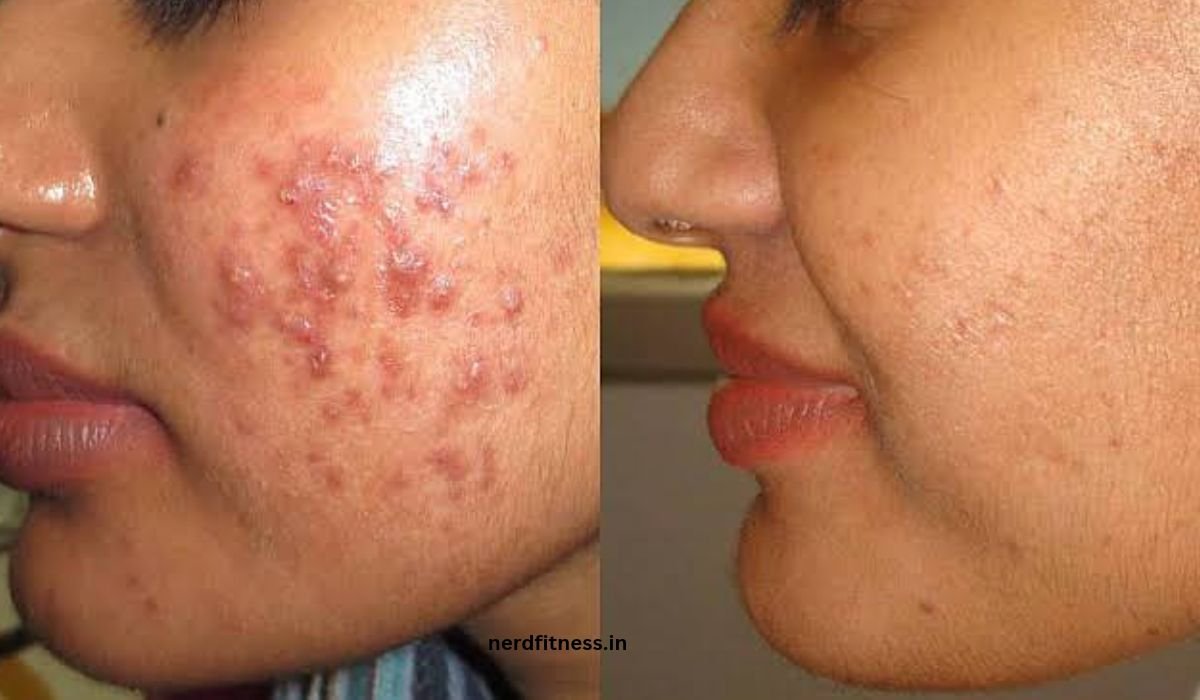 acne treatment